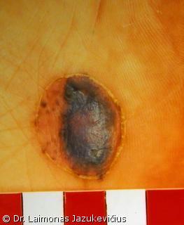 Akralin melanoma