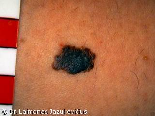 Odos paviriumi plintanti - radialin melanoma