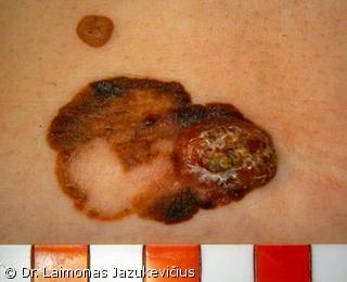 Mazginė melanoma