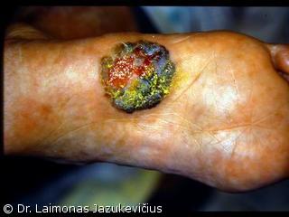 Akralin melanoma