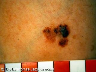 Odos paviriumi plintanti - radialin melanoma