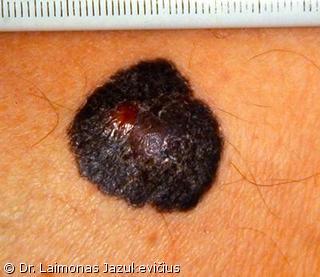 Mazginė melanoma