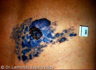Mazginė išopėjusi melanoma  su daugybiniais satelitais