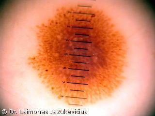 Dermalinis apgamas - dermoskopinis vaizdas