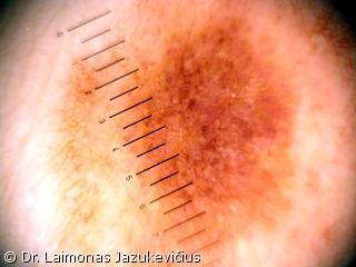 Halo nevus - dermoskopinis vaizdas