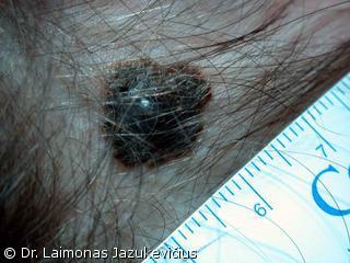 Mazgin melanoma - makro vaizdas